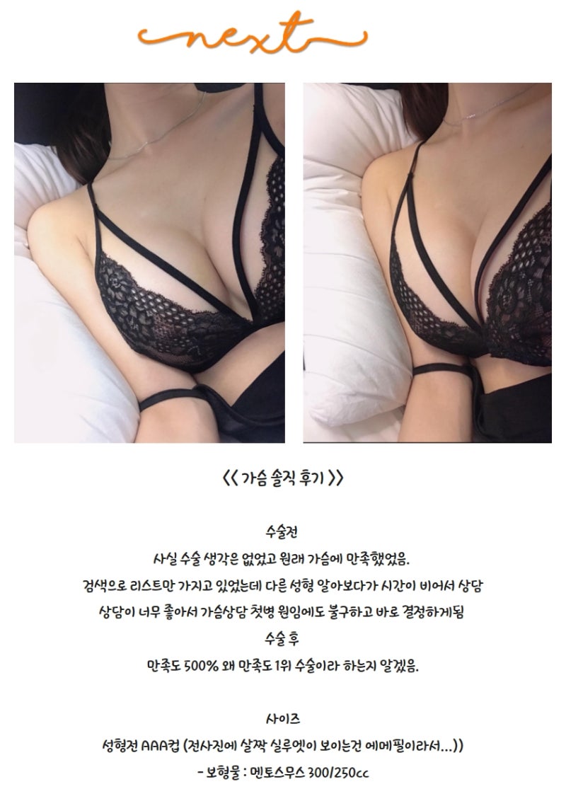 NEXT성형외과_바비톡_가슴성형후기_멘토스무스