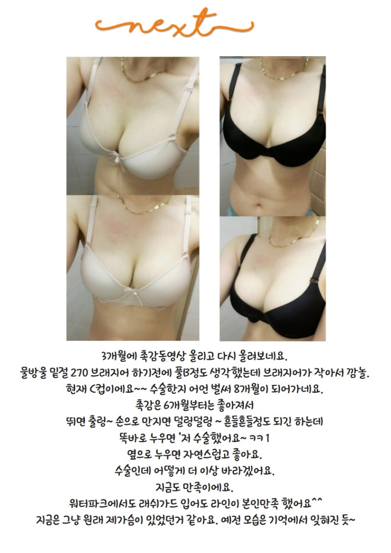 NEXT성형외과_바비톡 가슴성형_리얼후기