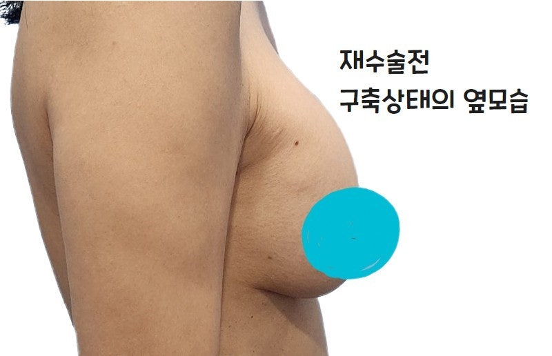식염수 백 파열 후 재수술 후기-가슴재수술