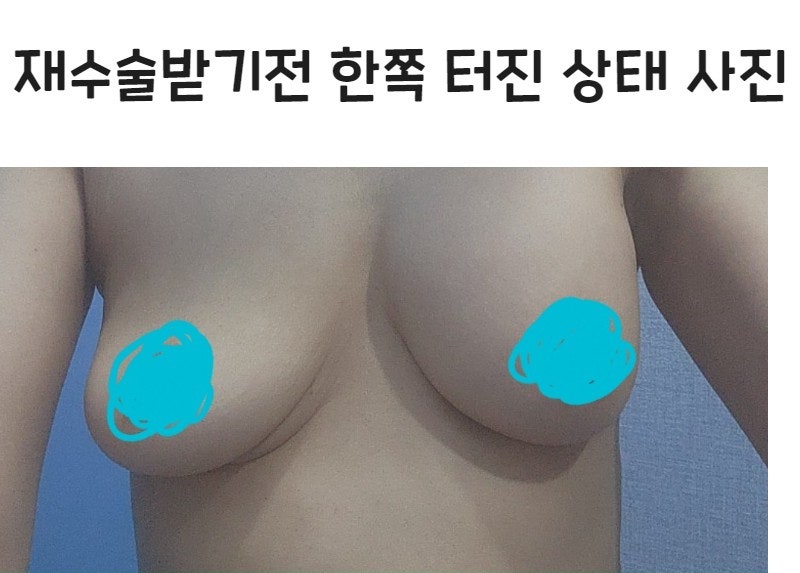 식염수 백 파열 후 재수술 후기-가슴재수술