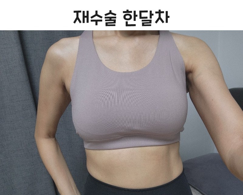 식염수 백 파열 후 재수술 후기-가슴재수술 사진 4