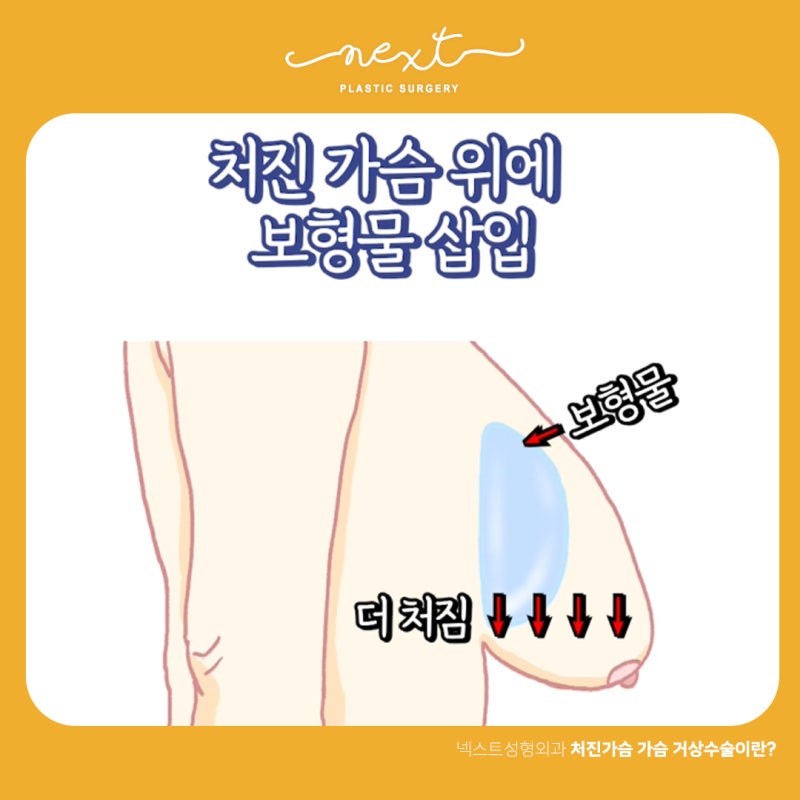 심한 다이어트나 출산과 수유 후 심하게 처지고 늘어진 가슴이라면..... 가슴거상수술? 사진 3
