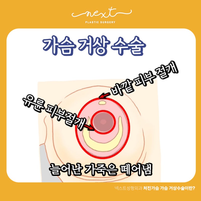 심한 다이어트나 출산과 수유 후 심하게 처지고 늘어진 가슴이라면..... 가슴거상수술? 사진 5