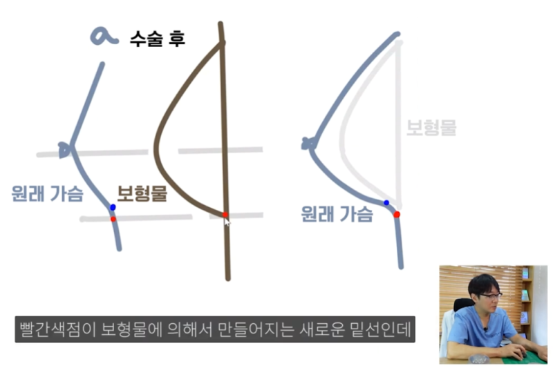 보형물 가슴확대수술 결정 시 중요한 두가지?? 사진 6